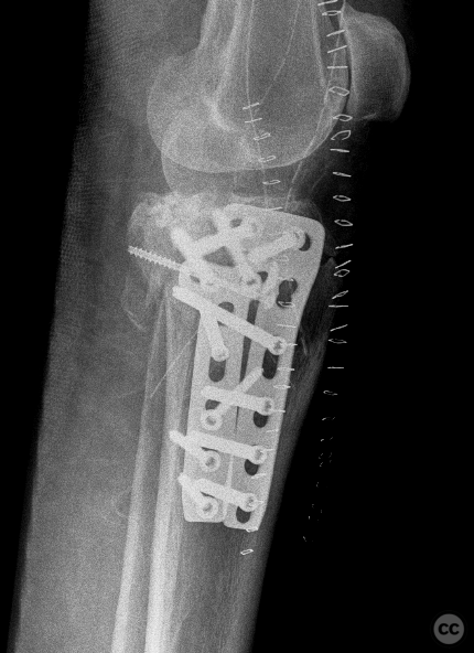 Failure Of Fixation And Secondary Collapse Of A Schatzker V-VI Tibial ...